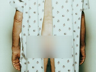privacy in germany photo of man with hospital gown